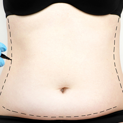 Abdominoplastia