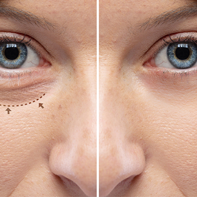 Blefaroplastia