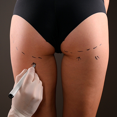 Gluteoplastia
