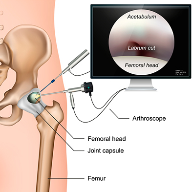 Artroscopia de quadril