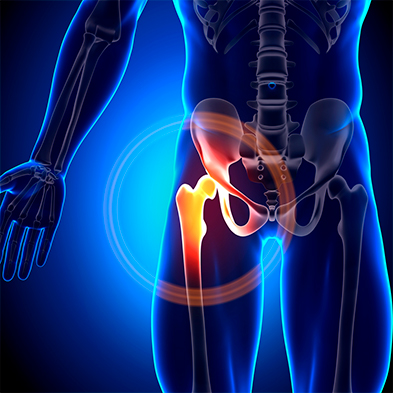 Impacto femoroacetabular