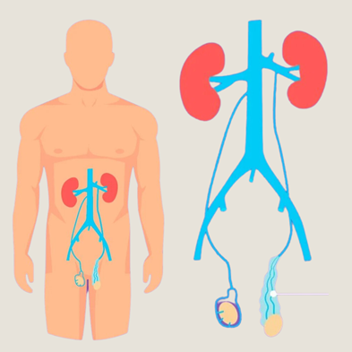 Varicocele