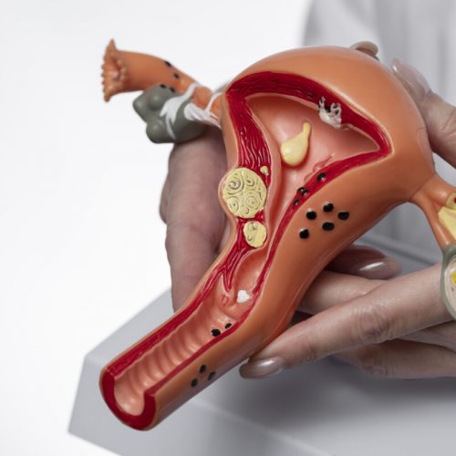 Quais exames fazer para detectar endometriose?